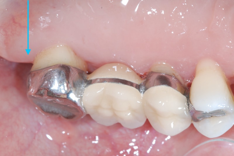 第二階段牙周病手術-右上第二大臼齒-手術後-牙齦恢復健康顏色