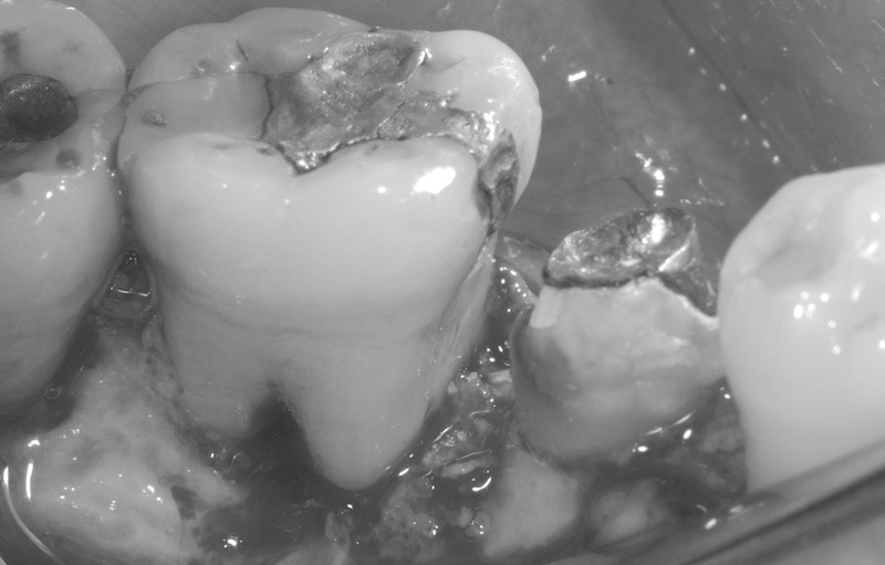 第二階段牙周病手術-右下第一第二大臼齒-手術中-徹底清創-牙周再生手術