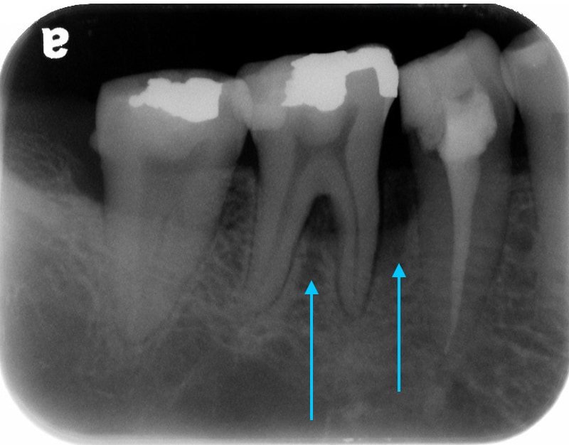 第二階段牙周病手術-右下第一第二大臼齒-手術前-X光片-牙周齒槽骨在牙根分岔處和骨缺損處
