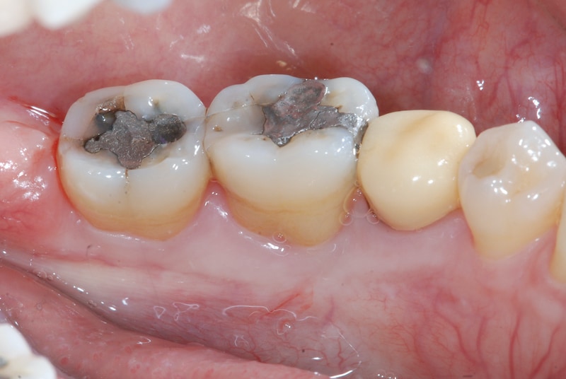 第二階段牙周病手術-右下第一第二大臼齒-手術前-數位照片