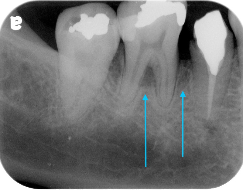 第二階段牙周病手術-右下第一第二大臼齒-手術後-牙周齒槽骨再生