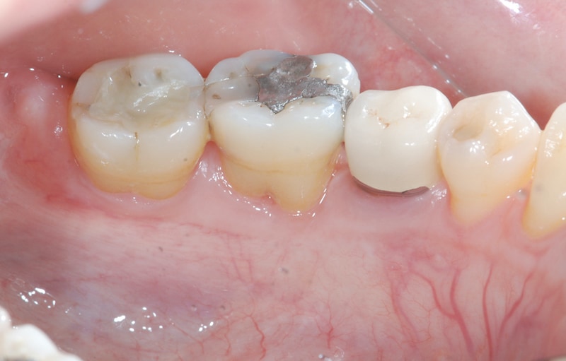 第二階段牙周病手術-右下第一第二大臼齒-牙周再生手術-手術後牙周組織再生