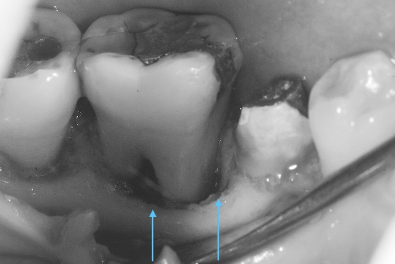 第二階段牙周病手術-右下第一第二大臼齒-齒槽骨破壞嚴重