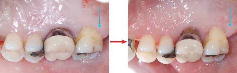 第二階段牙周病手術-左上第二大臼齒-手術前後比較-牙齦恢復健康