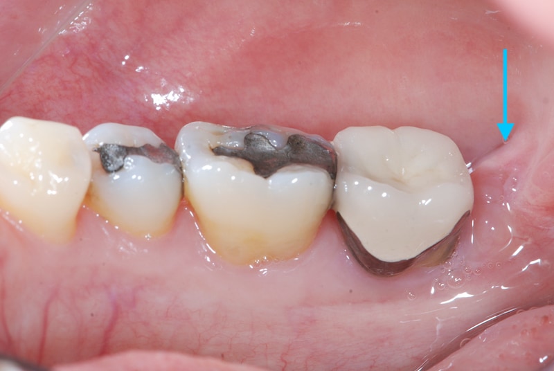 第二階段牙周病手術-左下第二大臼齒-去除牙周囊袋