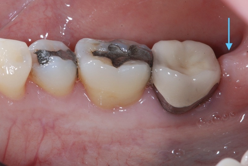 第二階段牙周病手術-左下第二大臼齒-手術前-殘存較深的牙周囊袋