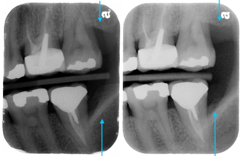 第二階段牙周病手術-左下第二大臼齒-手術後比較-牙周齒槽骨再生