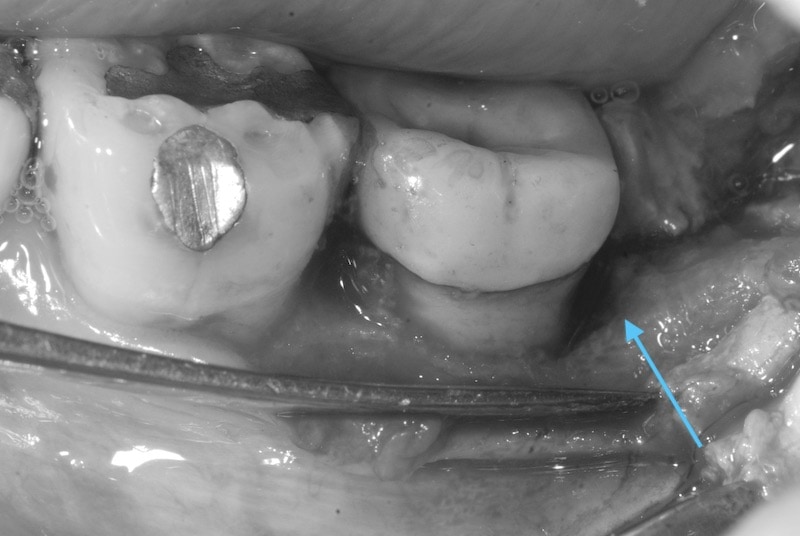 第二階段牙周病手術-左下第二大臼齒-牙周翻瓣手術-骨缺損處-牙周再生手術