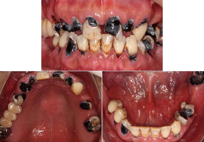 嚴重牙周病治療前口內狀況-嚴重蛀牙-牙齦發炎-桃園中壢牙周病