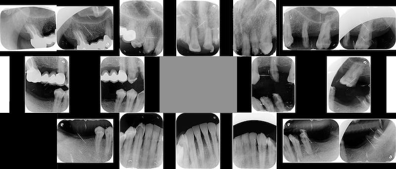 嚴重牙周病治療前-全口X光片-桃園中壢牙周病