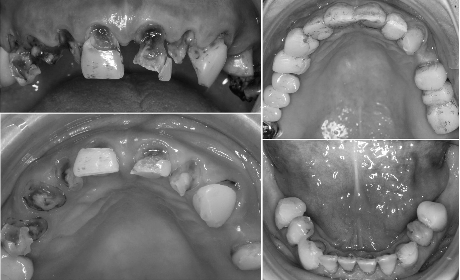 嚴重蛀牙-多顆蛀牙範圍很深-植牙前-全口臨時假牙-初期修復-桃園中壢牙周病