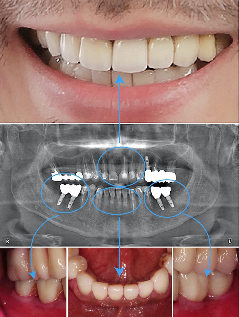 嚴重牙周病治療-植牙假牙-陶瓷貼片-全瓷冠-術後一年多追蹤-成效美觀且穩定-桃園中壢牙周病