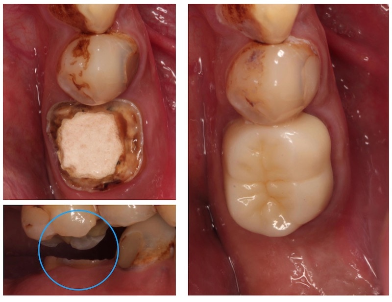 牙冠增長術-顯微根管治療-全瓷冠修復-右下第一大臼齒-牙周病專科-楊梅牙周病-推薦