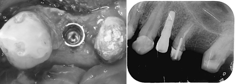 舒眠麻醉植牙-左上第一小臼齒-桃園中壢牙周病