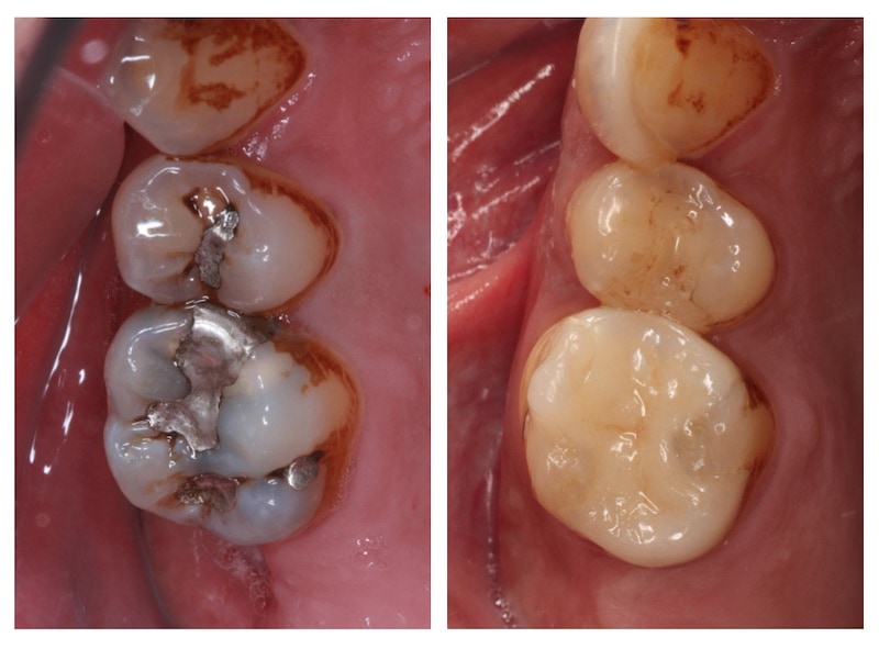 蛀牙補牙-銀粉填補-二次蛀牙-3D齒雕修復-牙周病專科-楊梅牙周病-推薦