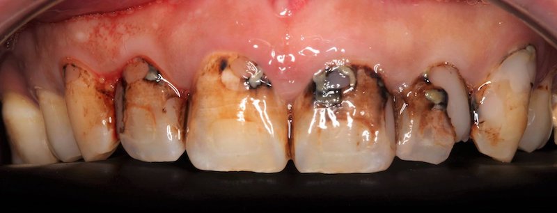 輕微牙周病治療-前牙嚴重蛀牙-陶瓷貼片修復-牙周病專科-楊梅牙周病-推薦