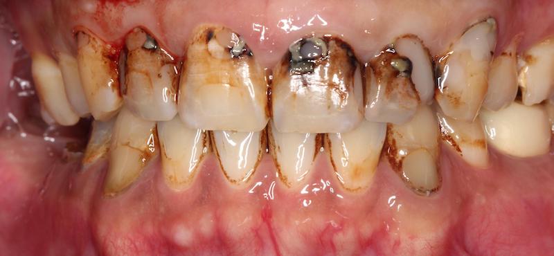 輕微牙周病治療-治療前-門牙蛀牙嚴重-齲齒-牙周病專科-楊梅牙周病-推薦