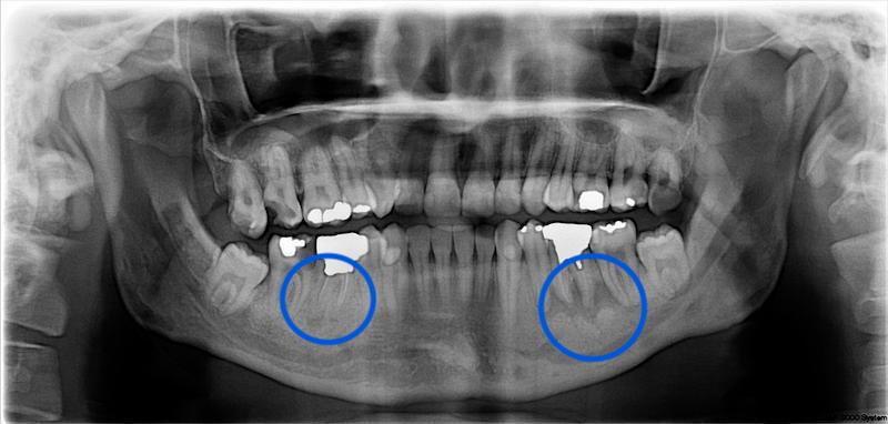 輕微牙周病治療-環口X光-齒槽骨-牙根尖-牙周病專科-楊梅牙周病-推薦