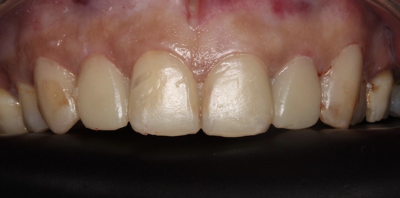 門牙蛀牙-陶瓷貼片治療-DSD數位微笑設計-試戴臨時樹脂材料-牙周病專科-楊梅牙周病-推薦