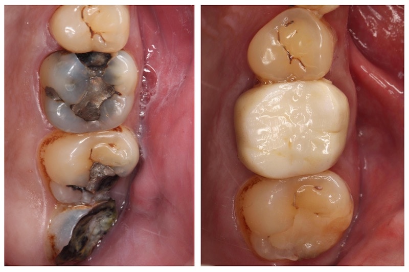 顯微根管治療-全瓷冠修復-左上第一大臼齒-牙周病專科-楊梅牙周病-推薦