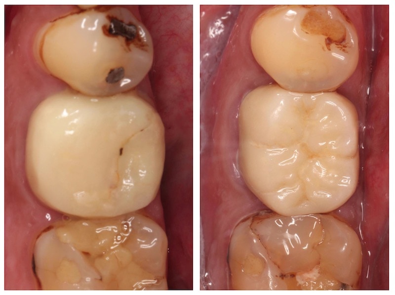 顯微根管治療-全瓷冠修復-左下第一大臼齒-牙周病專科-楊梅牙周病-推薦