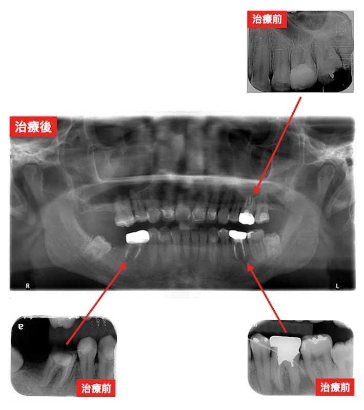 顯微根管治療-治療前後X光片-臼齒的根管都完整填補-牙周病專科-楊梅牙周病-推薦