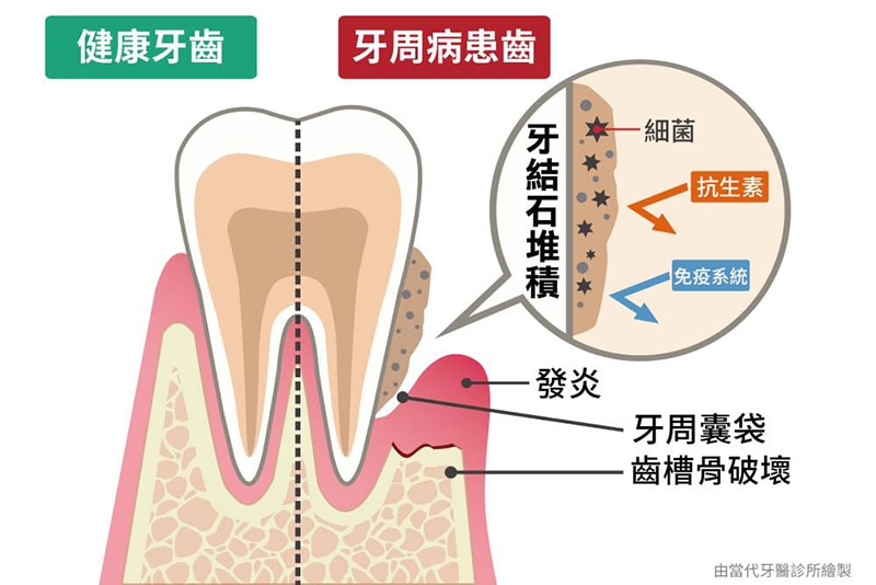 健康牙齒和牙周病牙齒結構剖析示意圖-cnews新聞網報導