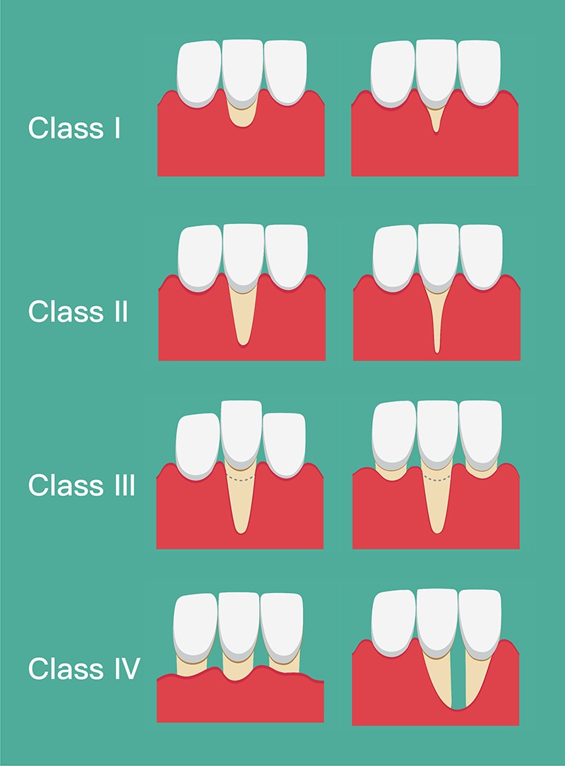 牙齦萎縮如何補救？牙周專科醫師詳解牙齦萎縮原因、症狀與治療方法