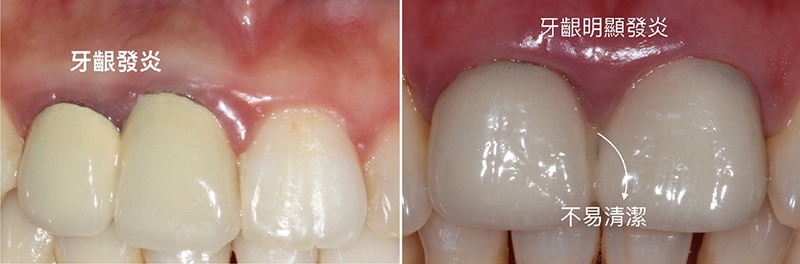 假牙不密合-生物寬度-牙齦發炎-牙齦萎縮-治療-桃園