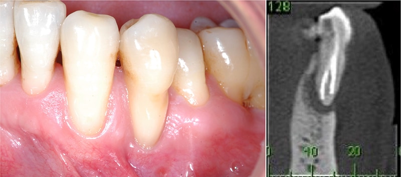 偏頰側齒列不整-牙齦萎縮-齒槽骨缺失-牙齦萎縮-治療-桃園