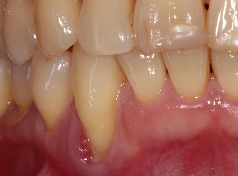全口嚴重牙周病-牙周病治療-治療前-牙齦紅腫發炎化膿-牙齦萎縮-治療-桃園