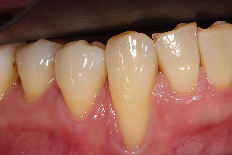 全口嚴重牙周病-牙周病治療-治療後-牙齦紅腫緩解-牙齦萎縮-治療-桃園