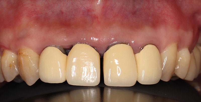 嚴重牙齦萎縮-手術前-舊假牙門牙位移-牙縫大-牙齦萎縮-治療-桃園