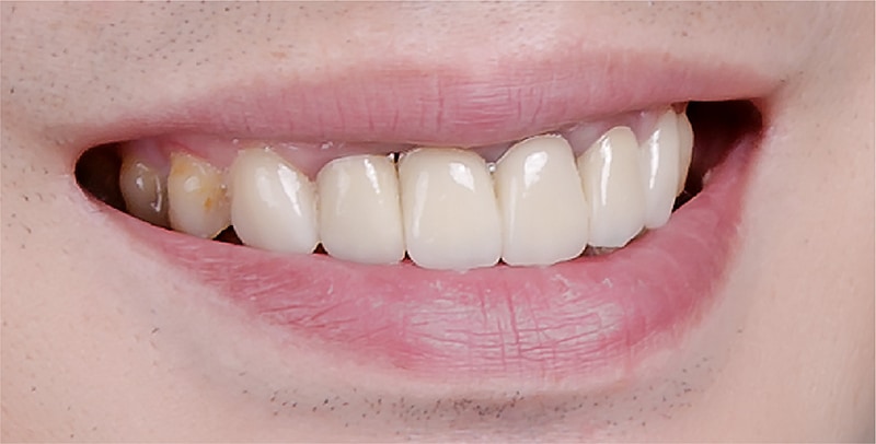 嚴重牙齦萎縮-手術後-全瓷冠-陶瓷貼片-牙齦萎縮-治療-桃園