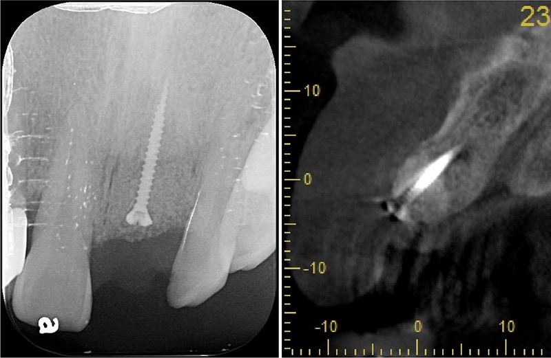 嚴重牙齦萎縮-植牙-拔牙-手術中-補骨粉-牙齦萎縮-治療-桃園