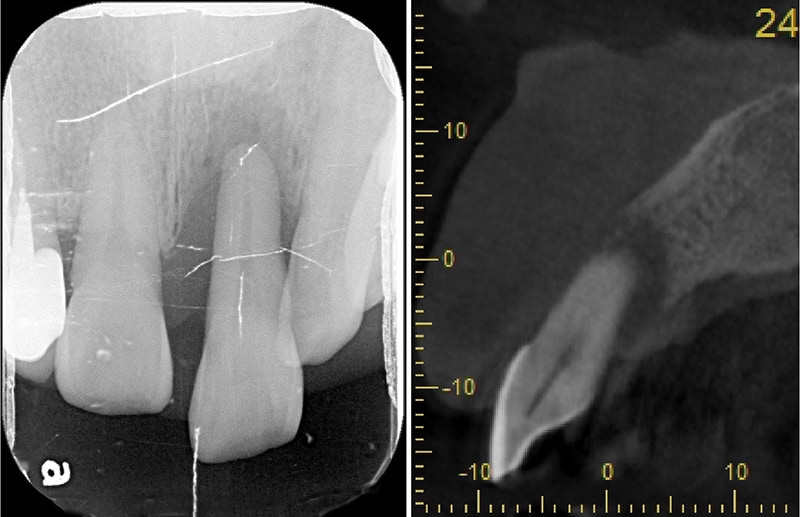 嚴重牙齦萎縮-植牙-拔牙-手術前-X光片-電腦斷層影像-齒槽骨破壞超過牙根尖端-牙齦萎縮-治療-桃園