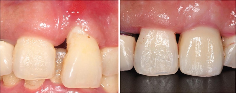 嚴重牙齦萎縮-植牙-拔牙-手術前後比較-牙齦萎縮-治療-桃園