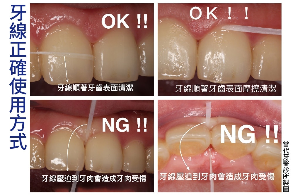 正確與錯誤的牙線使用方式-葉立維醫師-桃園-當代牙醫