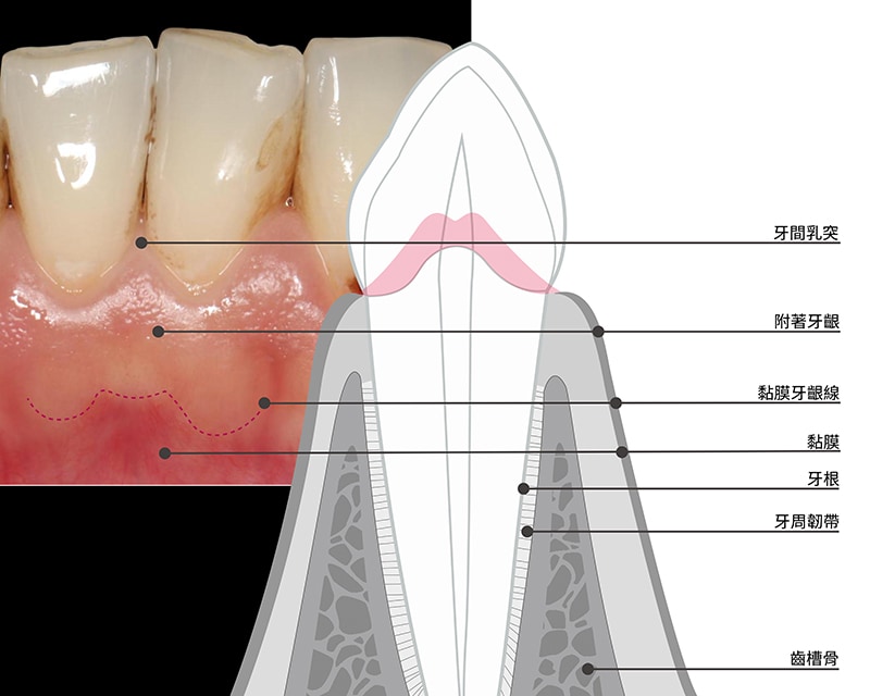 無牙齦萎縮的健康牙齦-牙齒牙齦-葉立維醫師-桃園-牙齦萎縮-牙周病