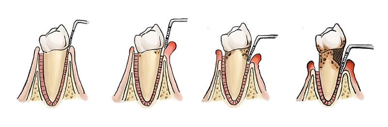 牙周病-牙齦萎縮-示意圖-葉立維醫師-桃園牙周病