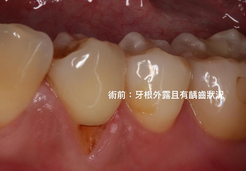 牙根覆蓋術-水雷射-牙周再生-手術前-牙根外露-牙根蛀牙-牙根敏感-牙齦萎縮-治療-桃園