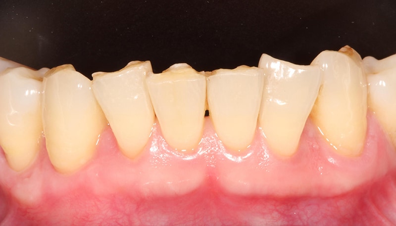 牙根覆蓋術-牙周再生-水雷射-手術後-牙根完全覆蓋-牙齦萎縮-治療-桃園