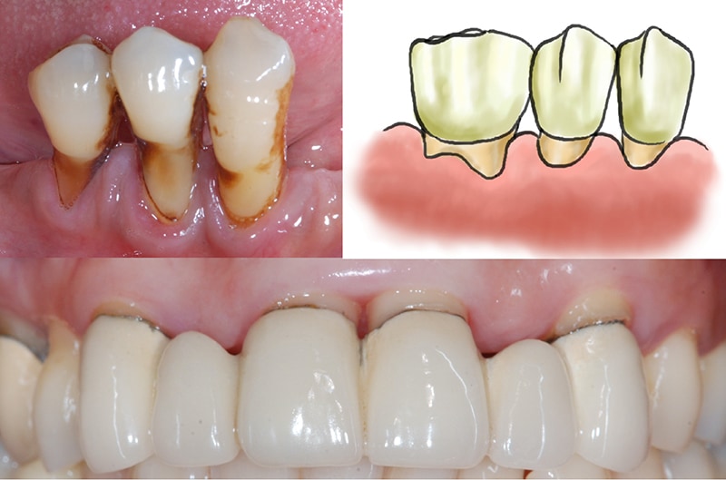 牙齦萎縮-症狀-牙根外露-牙縫變大-葉立維醫師-桃園-牙齦萎縮-治療-推薦