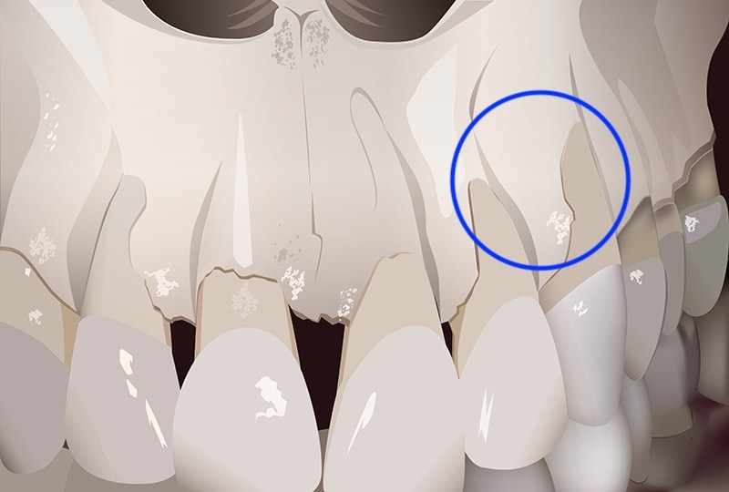 牙齦萎縮原因-牙齦薄-薄型牙齦-齒槽骨天生缺損-牙齦萎縮-治療-桃園