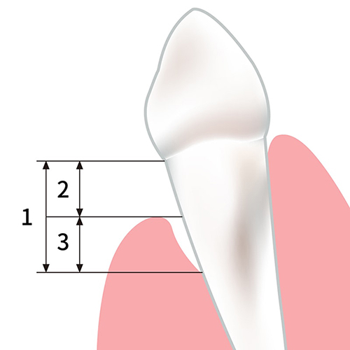 牙齦萎縮示意圖-牙根外露-牙周囊袋變深-葉立維醫師-桃園牙周病