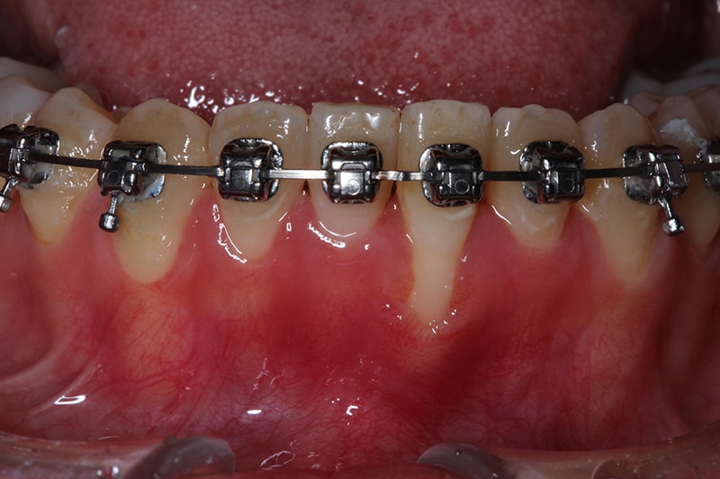 矯正中牙齦嚴重萎縮-牙根覆蓋術-牙周再生-水雷射-手術前-牙根外露-角化牙齦太薄-牙齦萎縮-治療-桃園