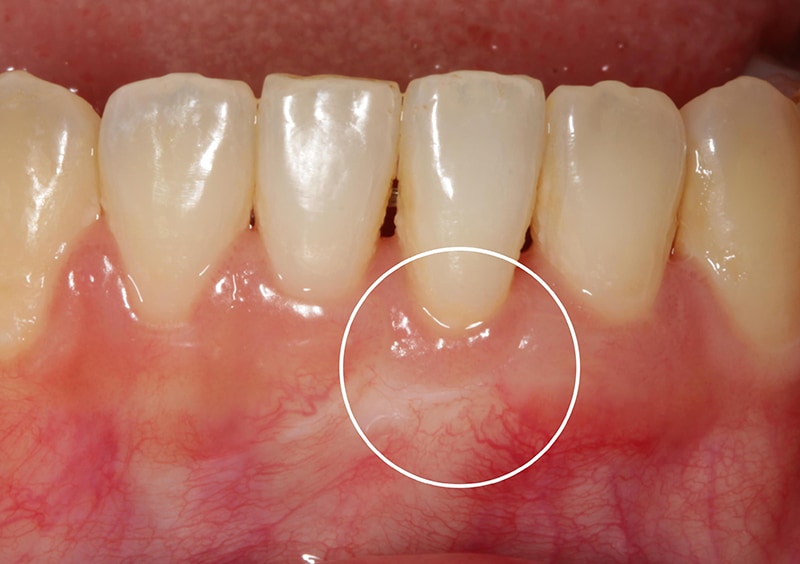 矯正中牙齦嚴重萎縮-牙根覆蓋術-牙周再生-水雷射-手術後-牙齦萎縮-治療-桃園