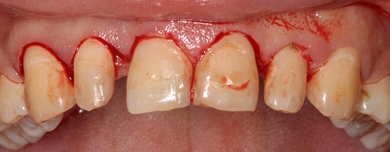 傳統牙周手術-牙齦切割-流血