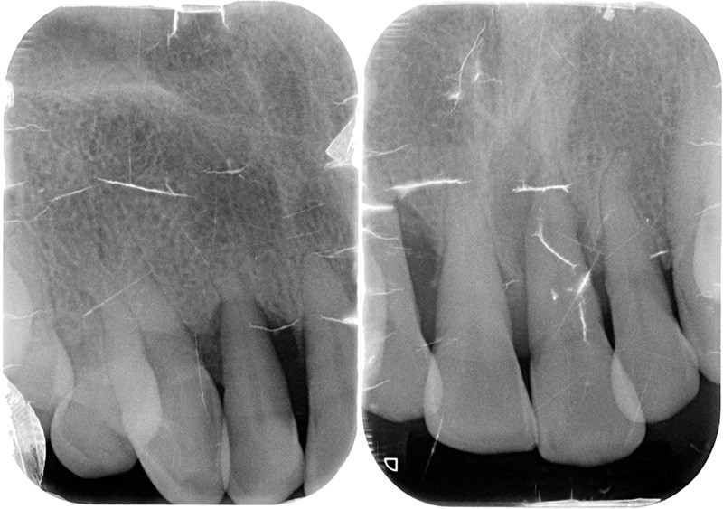 水雷射牙周病治療-案例-微創水雷射輔助牙周再生-治療前上顎局部X光-齒槽骨支撐狀態差