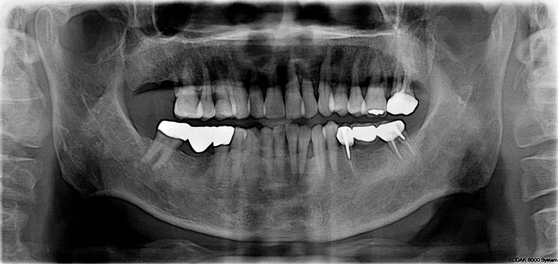 水雷射牙周病治療-案例-微創水雷射輔助牙周再生-治療前全口X光片-前牙齒槽骨破壞嚴重